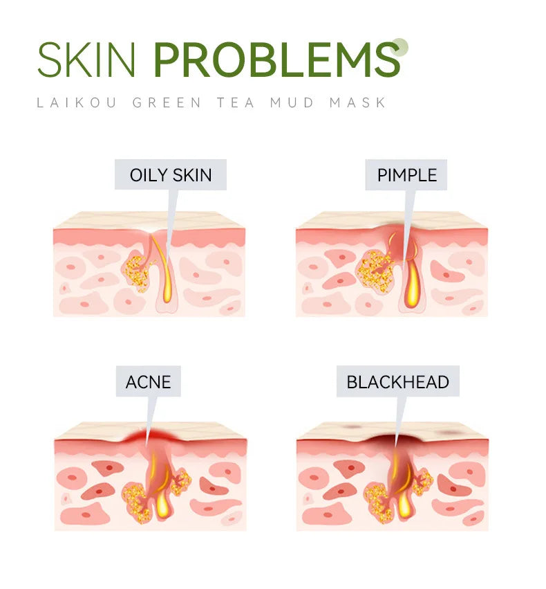 6 Months Deep Treatment Pack Green Tea Mud Mask - Best Mud